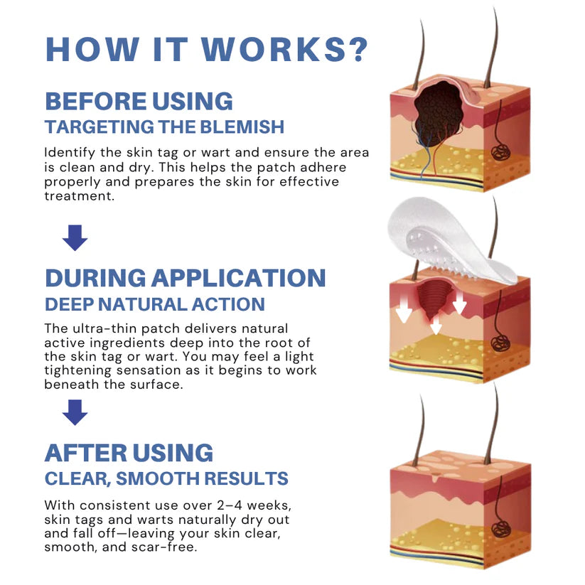 mistsilt® Moles & Warts Removing Skin Tag Patch