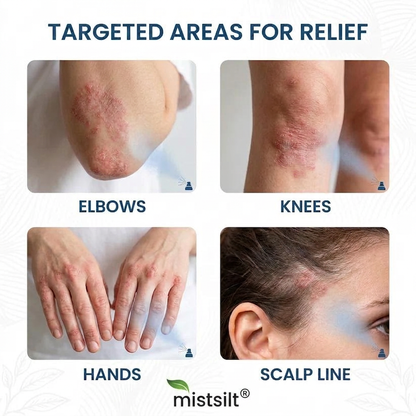 mistsilt® Magnesium Botanic Spray – Advanced Skin Recovery for Psoriasis & Eczema | Rapid Soothing, Steroid-Free