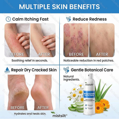 mistsilt® Magnesium Botanic Spray – Advanced Skin Recovery for Psoriasis & Eczema | Rapid Soothing, Steroid-Free